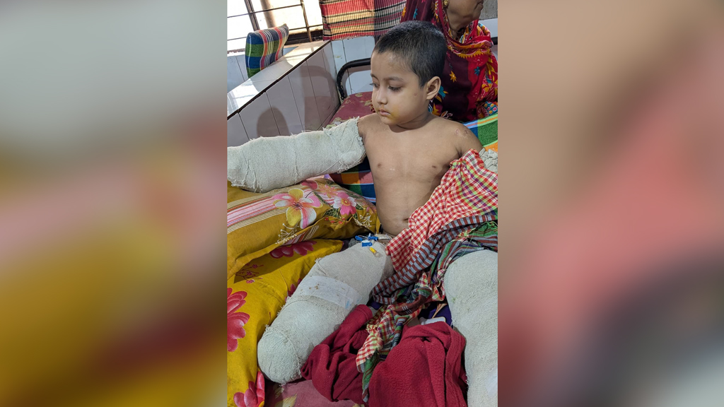 অপচিকিৎসায় হাত-পা হারানো শিশু তানভীর অবশেষে মারা গেল