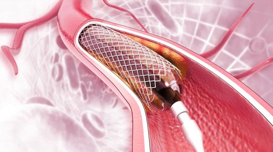 হার্টের রিংয়ের দাম কমছে